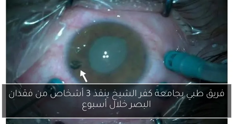 فريق طبي بجامعة كفر الشيخ ينقذ 3 أشخاص من فقدان البصر خلال أسبوع