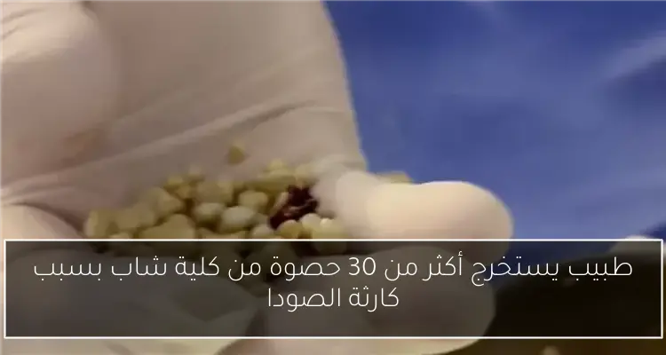 طبيب يستخرج أكثر من 30 حصوة من كلية شاب بسبب كارثة الصودا