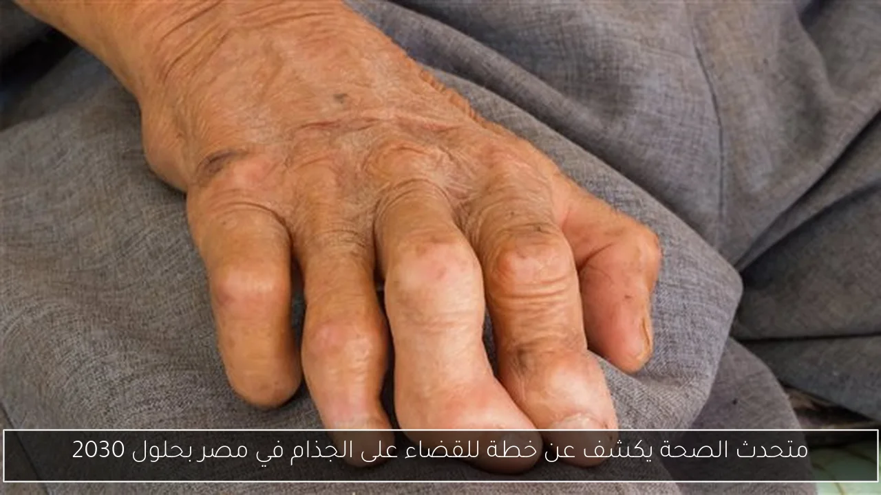 متحدث الصحة يكشف عن خطة للقضاء على الجذام في مصر بحلول 2030